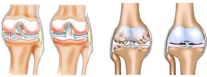 What is Arthritis and Arthropathy